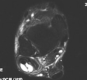 Peroneal Tendonitis MRI 2